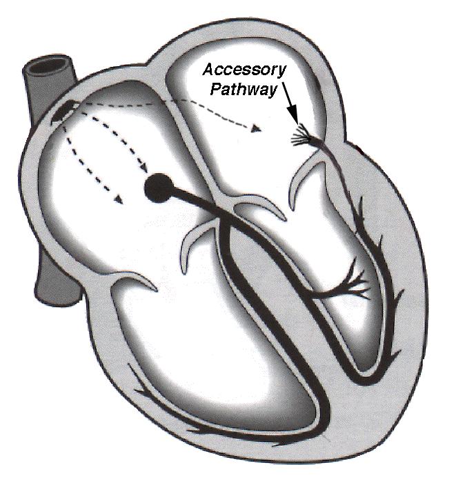 Wolf-Parkinson-White Syndrome (WPW) The accessory conduction pathways
