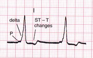 12 sec) with a normal p wave Slurred