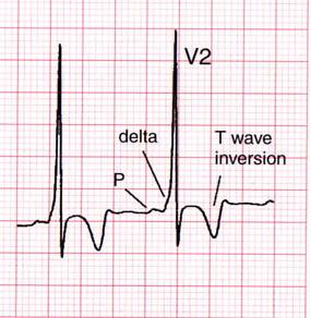 pre-excitation (delta wave) Wide QRS