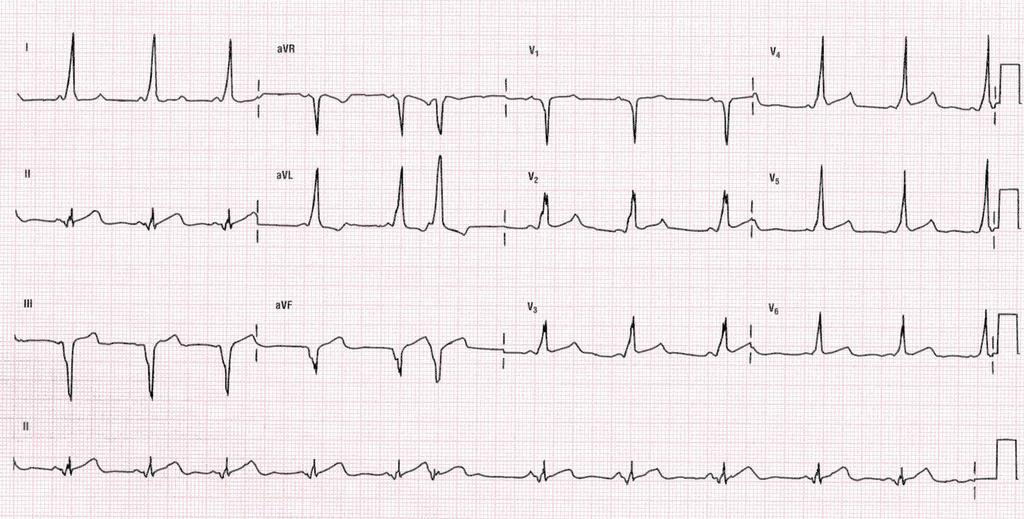Type B with pseudoinfarct pattern in the inferior leads.