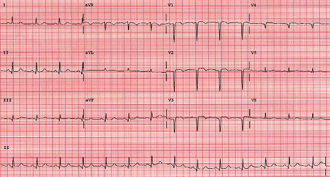 Infarct in the antereoseptal and anterior wall (Q waves in V2-V4