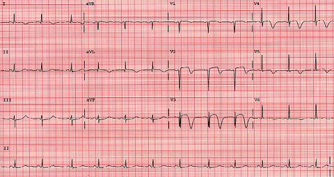 Ischemia across the entire anterior and lateral wall (T wave inversions in V2-V6, I and avl).