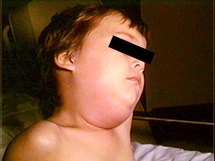 Mumps Mumps is a viral infection caused by a paramyxovirus. It occurs most commonly in children and is very contagious.