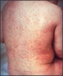 It may continue to spread to the chest, abdomen, legs and arms. The rubella rash usually lasts for about 3 to 7 days.