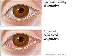 Conjunctivitis (infective) Conjunctivitis refers to any irritation or inflammation of the conjunctiva of the eyes.
