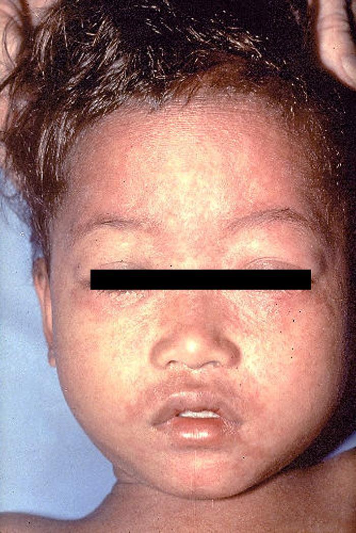 Measles Measles (sometimes known as English measles or rubeola) is a highly contagious disease caused by infection with a morbillivirus.