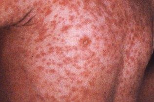 Measles Symptoms 10 days after infected Cold-like symptoms Red eyes Fever White spots in mouth