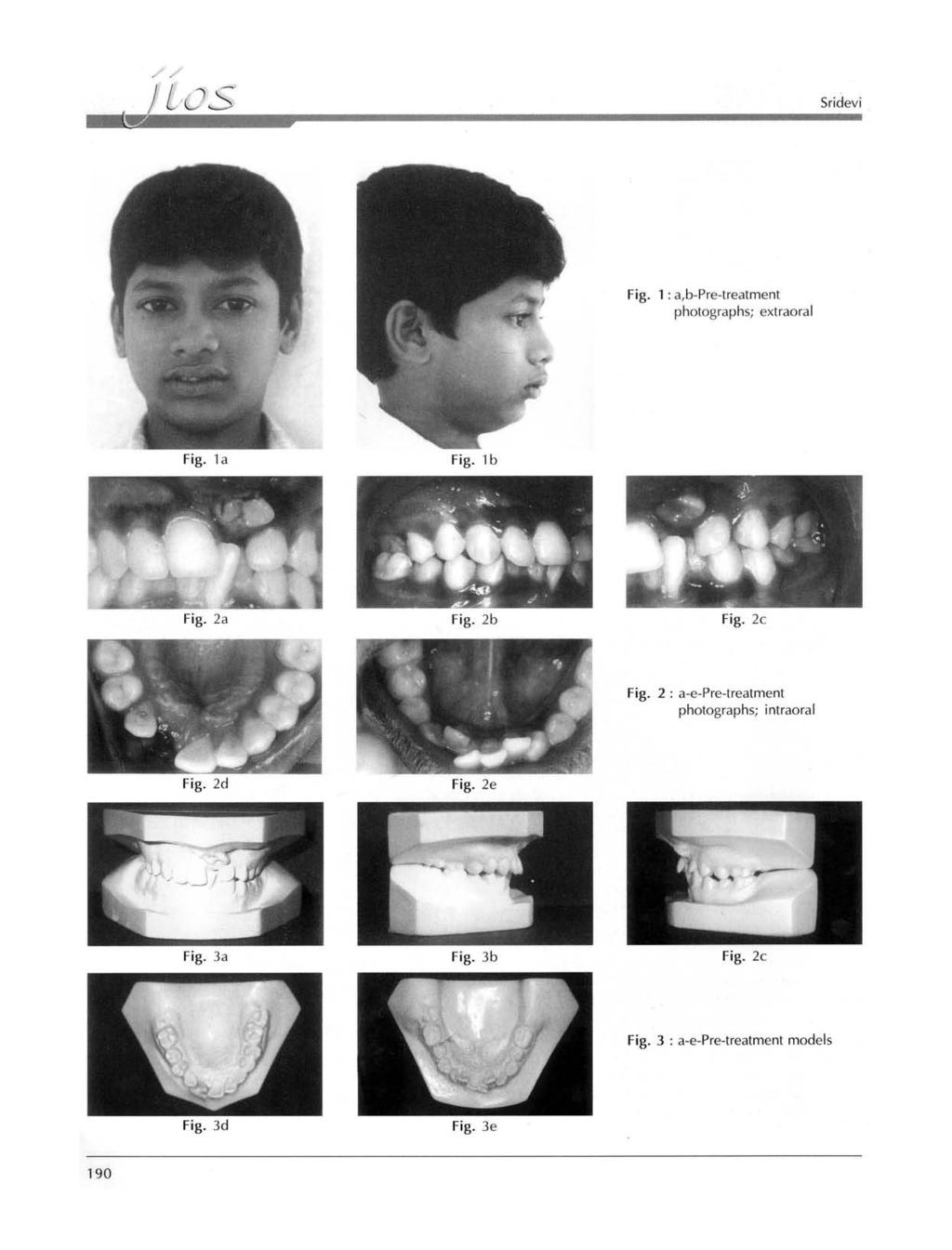 Sridevi Fig. 1 : a,b-pre-treatment photographs; extraoral Fig. 1a Fig. 1 b Fig. 2a Fig. 2b Fig. 2c Fig.