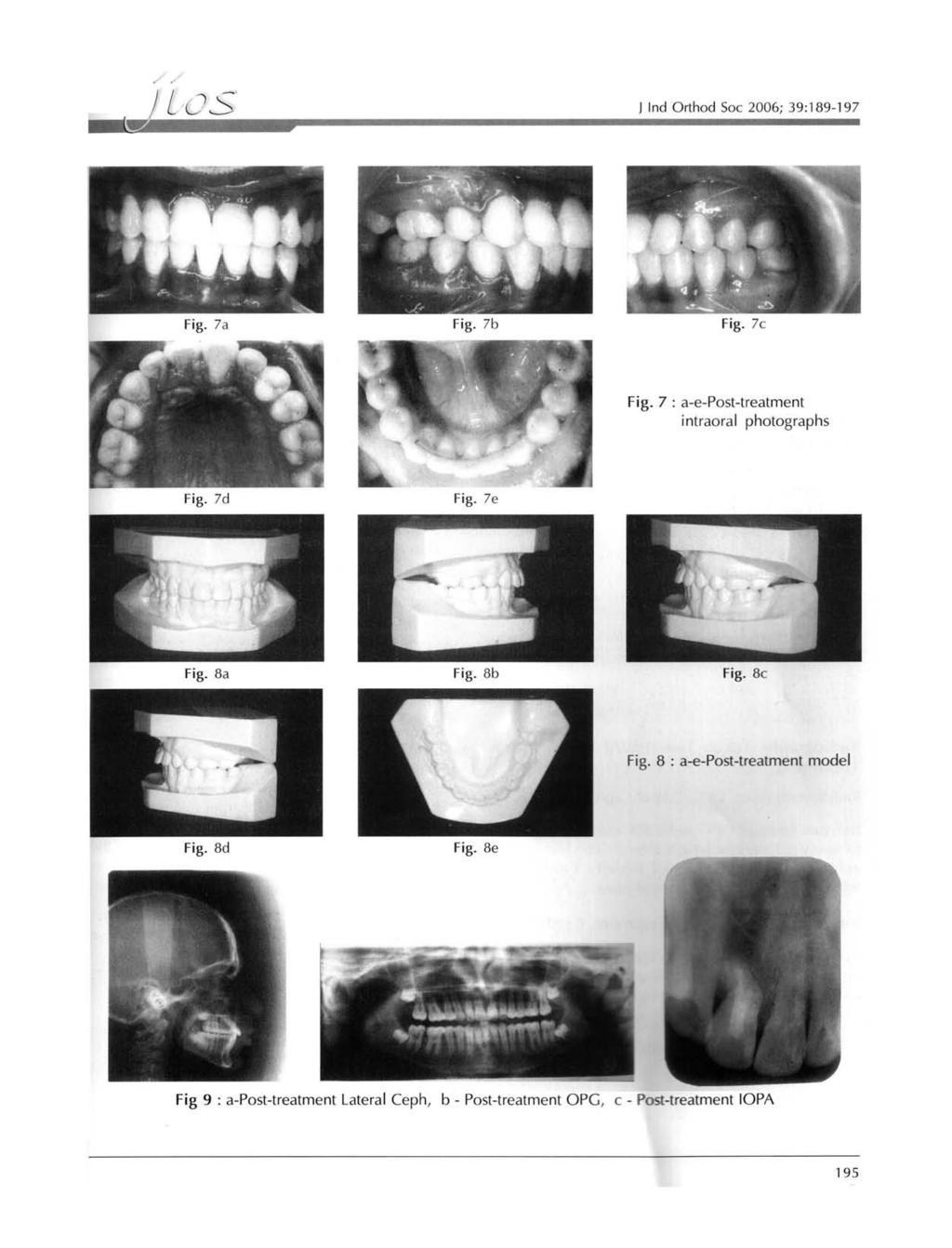 '.. // J LcJ~ J Ind Orthod Soc 2006; 39: 189-197 Fig. 7c Fig. 7 : a-e-post-treatment intraoral photographs Fig. 8c Fig.