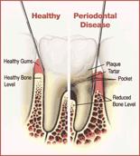 Consequences of dental infection Production of organic acids results in destruction of protecting dental enamel (Decalcification) Formation of deep pockets Accumulation of substrates and colonization