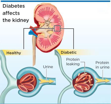 High Levels Of Blood Glucose Levels Causes Diabetic Nephropathy It causes damage to the