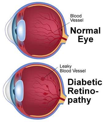 retinopathy involves changes to retinal