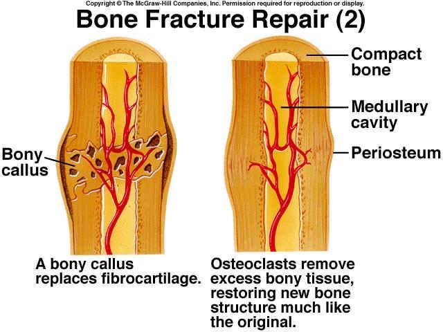 Fracture Treatment When a physician pulls on