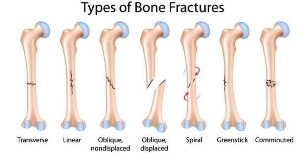 Fractures open fracture-breaks through skin closed fracture-does NOT break