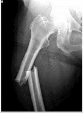 bone that is broken?