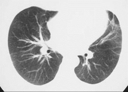 Ground glass opacifications is seen in the nondependent part of the lungs.