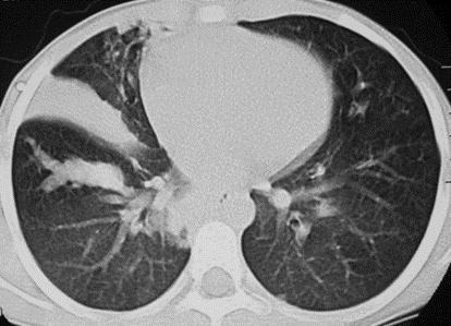 pressures. HRCT may show main pulmonary artery enlargement, ground-glass opacities in a centrilobar distribution, and mediastinal lymphadenopathy.