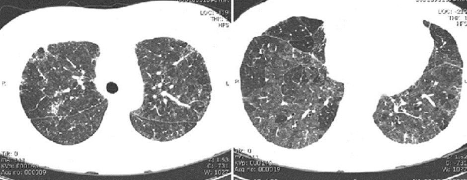 On the right, there is diffuse interstitial disease with ground glass opacities, septal thickening and areas of decreased lung density with multifocal bronchiolitis.