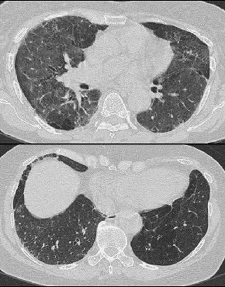 Figure 8 bilateral diffuse alveolar opacities and interstitial thickening is seen in a patient on Penicillamine. There are also bilateral pleural effusions.