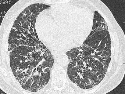 On the right is the HRCT, showing scattered areas of ground glass opacity, sub-pleural reticular opacities and areas of honeycombing suggestive of severe pulmonary fibrosis.