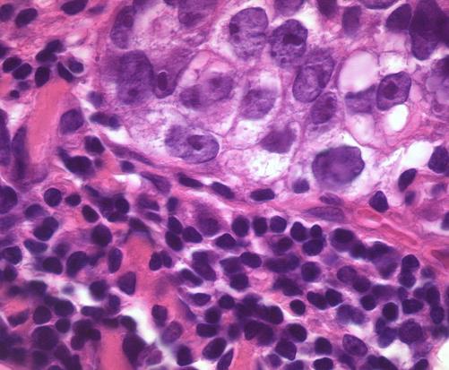 Is breast cancer immunogenic?