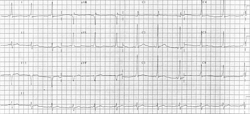 When an individual is in normal sinus rhythm, the ECG characteristics of WPW syndrome are a short PR interval, widened QRS complex (greater than 120 ms in length) with slurred upstroke of the QRS