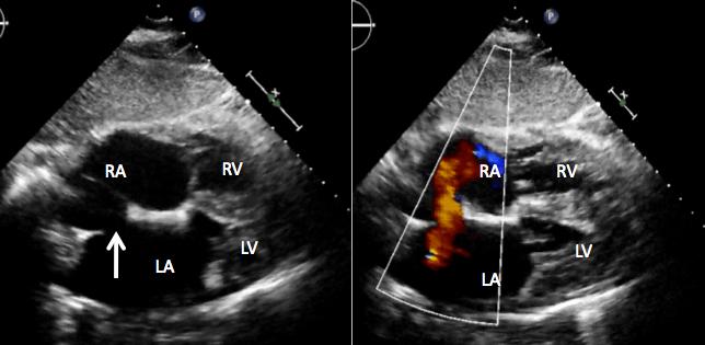 Atrial Septal Defects Investigations CXR signs of heart failure ECG partial right bundle branch block Echo & Doppler Management
