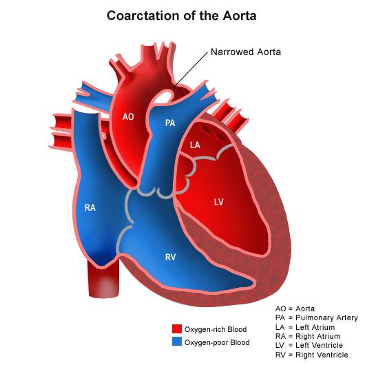 Coarctation of the aorta! Only 5% of congenital heart defects!