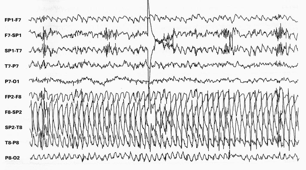 Reuber / 25 M. Reuber / 26 EEG during a right temporomesial seizure (1) EEG during a right temporomesial seizure (2) M. Reuber / 27 M.
