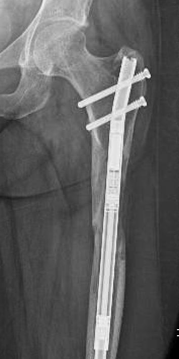 The circular frame over the distal femur was programmed at an equal daily rate of compression.