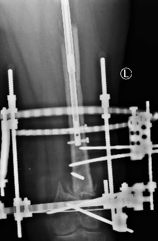permitted once at least 2 cortices of regenerate bone were seen on radiographs. Results The patient was followed every 6 weeks with radiographs of the femur.