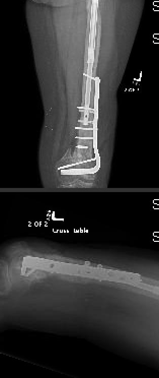 Two cortices of regenerate bone were noted on both AP and lateral radiographs.