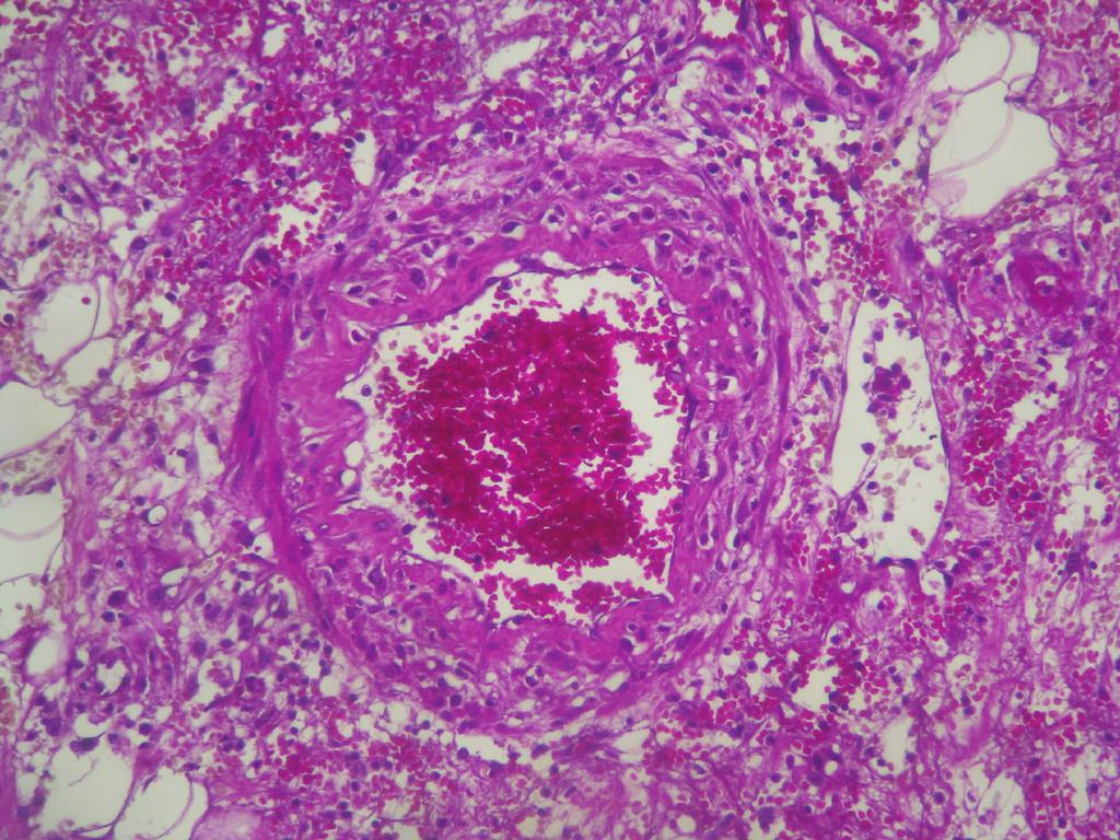 Figure 4: Fibrinoid necrosis with inflammatory infiltrate rich in neutrophils (HE 400). progressive withdrawal of prednisone was accomplished. One year after, PAN has not relapsed. 3.