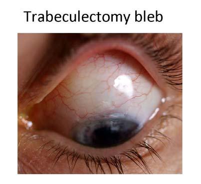 The drainage bleb is not usually visible to the naked eye after the trabeculectomy operation but may sometimes be seen if the patient looks in the mirror and raises the upper eyelid.