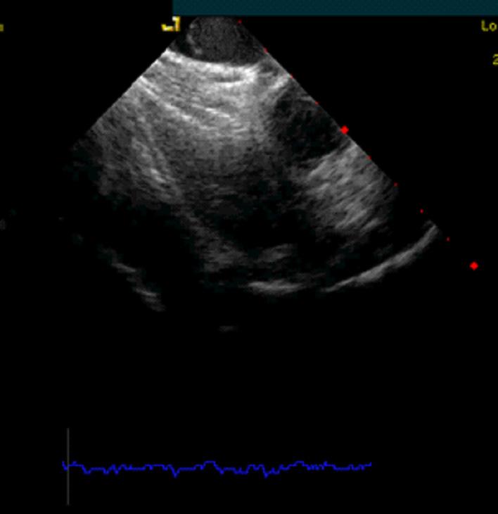 Figure 6. Acceptable placement. Figure 7 shows impingement of the device on the aortic root please note patients in whom the device physically impinges on (i.e. indents or distorts) the aortic root, may be at increased risk of erosion.