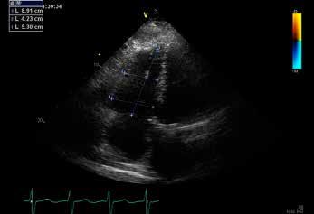 Transthoracic echocardiography before VSD