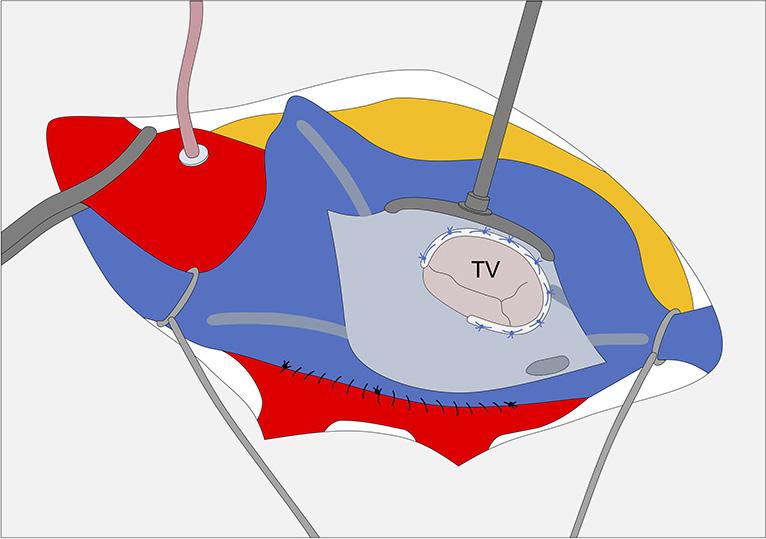 Journal of Visualized Surgery, 2017 Page 5 of 5 References Figure 8 Tricuspid valve repair with a ring and atrial fibrillation cryoablation right atrium lesion set. TV, tricuspid valve.