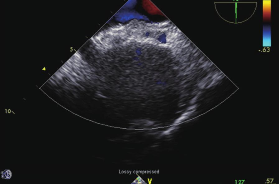 C D E F Fig. 1. Transesophageal echocardiography revealed about 10.1 mm (antero-superior rim, long arrow) and 14.