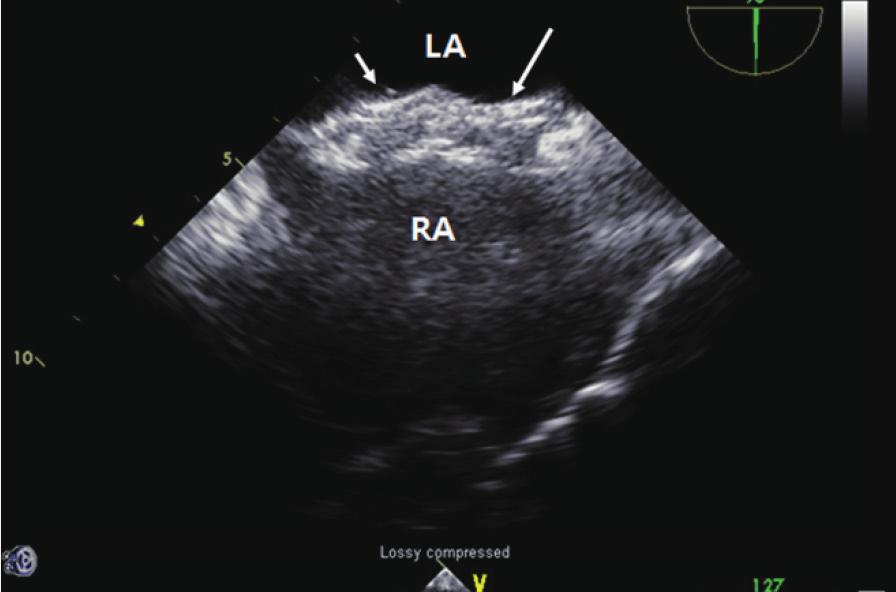 postero-inferior rim (Fig. 1D), with de novo left to right shunt (Fig. 1E), and the other SO showed stable position.