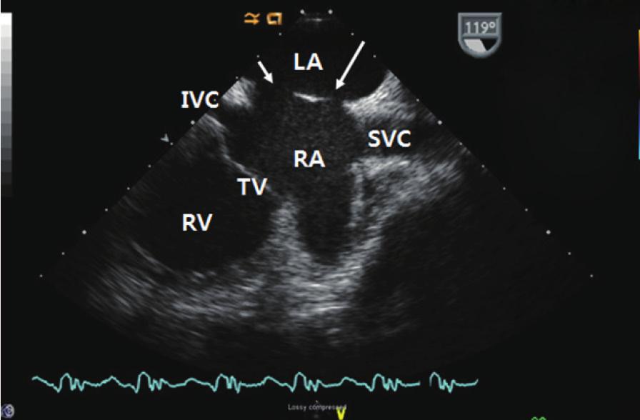 ecause TTE showed decreased amounts of shunt through the remained SD with decreased size of the right ventricle, percutaneous retrieval of