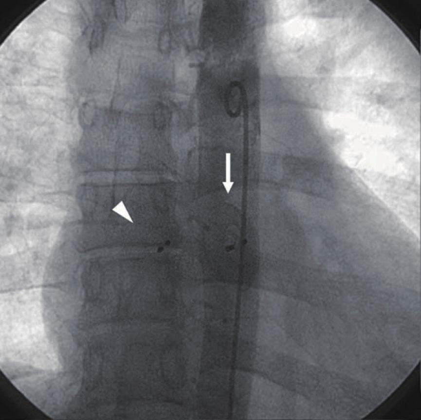 (17) studied in 28 patients with multiple SD and found that the ability of the Helex Septal Occluder (HSO) devices to overlap or sandwich each other may make it an ideal choice
