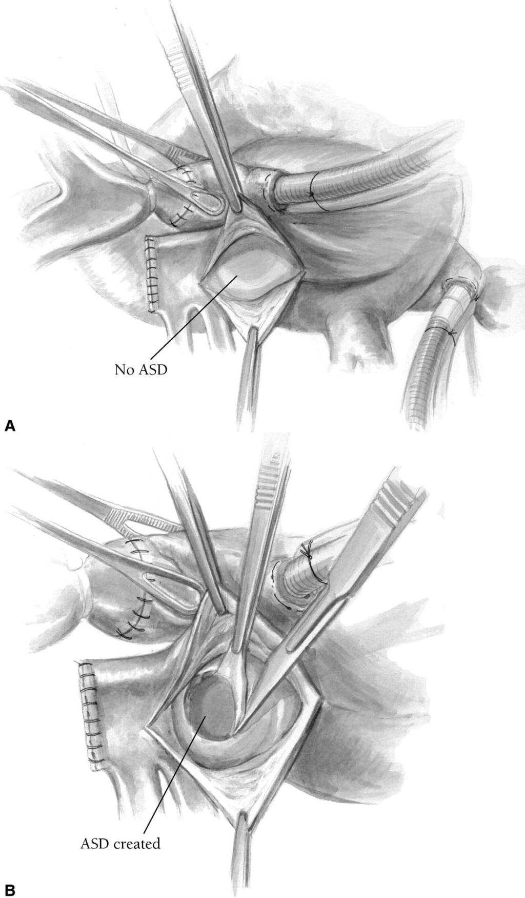The Warden procedure 31 Figure 9 If an atrial septal defect is not present, a defect in the interatrial septum can be created near the usual location of a sinus venosus