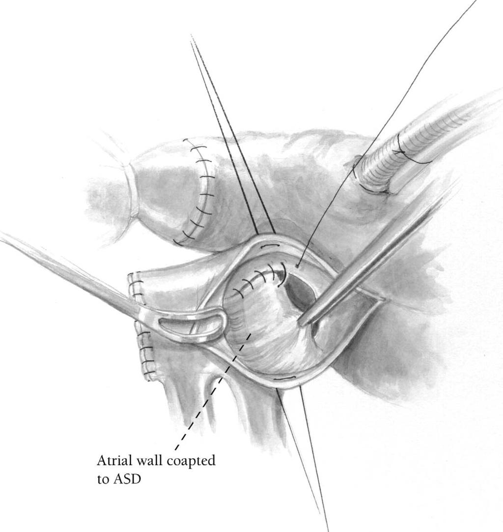 The Warden procedure 29 Figure 7 The anomalous right pulmonary venous return is directed across the sinus venosus atrial septal defect into the left atrium by