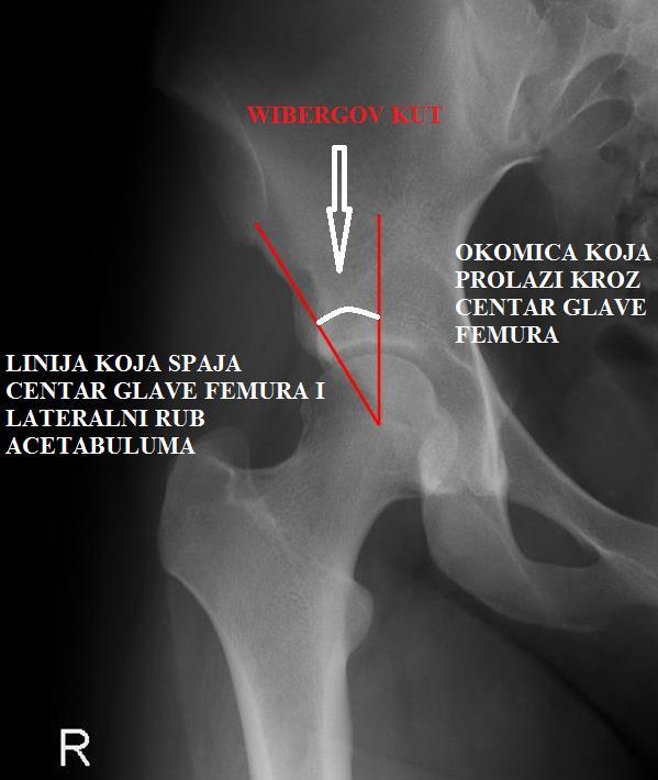Slika 5. Prikaz Wibergovog kuta. Preuzeto i modificarno sa: http://www.orthopaedicsone.