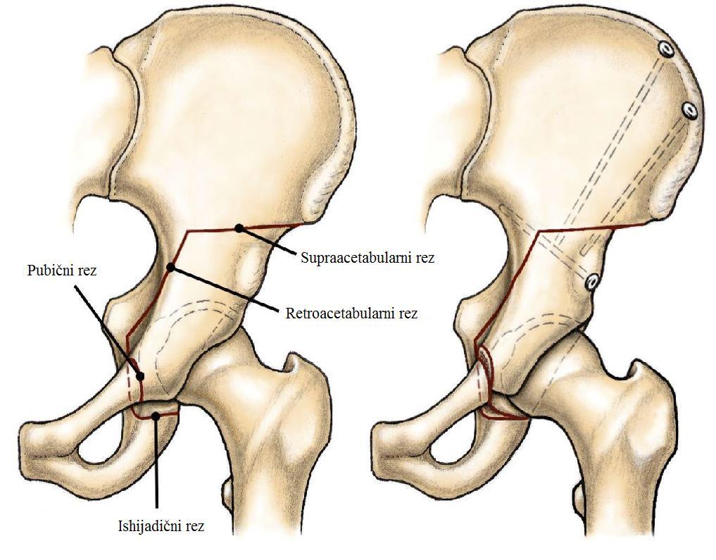 acetabulum se odvoji od ostatka zdjelice i postavi na novu poziciju te se učvrsti vijcima tako da bolje prekriva lateralni i anteriorni dio femura.