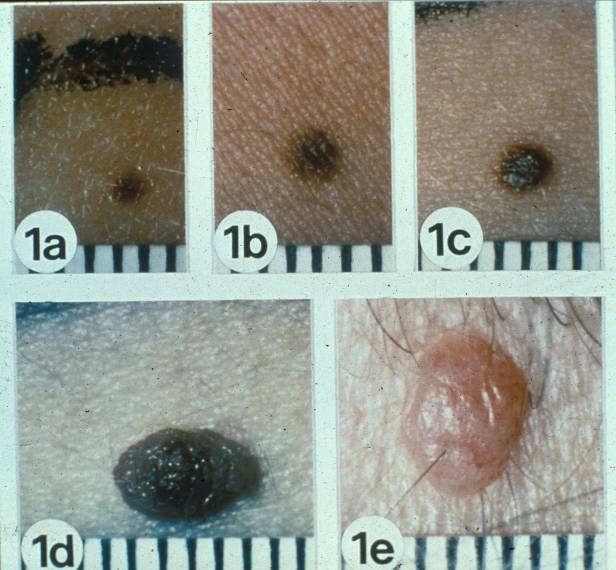 Distinguishing Pigmented Skin Lesions and Melanoma Toby Maurer, MD University of California, San Francisco Epidemiology of Melanoma Lifetime risk of an American developing melanoma 1935: 1 in 1500