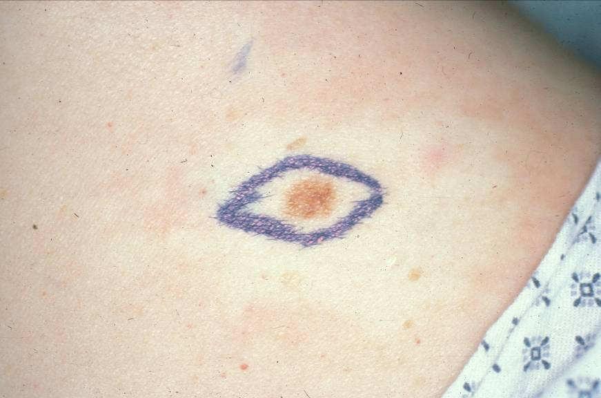 How to Diagnose If melanoma is suspected, an excisional biopsy is recommended If the lesion is