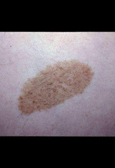 Congenital Nevi < 1 cm - 1% Lifetime risk of melanoma 1-5 cm - Unknown risk > 5 cm