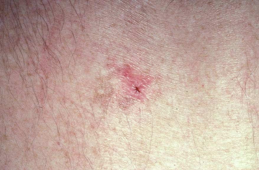 How do we increase our chances of finding thin melanomas Full body exam on everybody?
