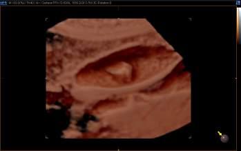 Low-MI (Contrast-Enhanced Ultrasound) Low-MI is a technology that uses contrast agents when performing